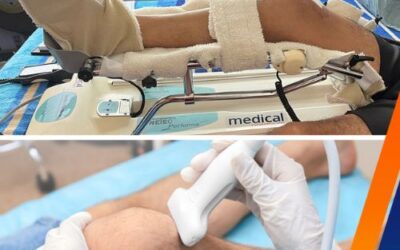 Movilizador Pasivo vs. Terapia tradicional: ¿Qué es Mejor en 2025 según expertos?